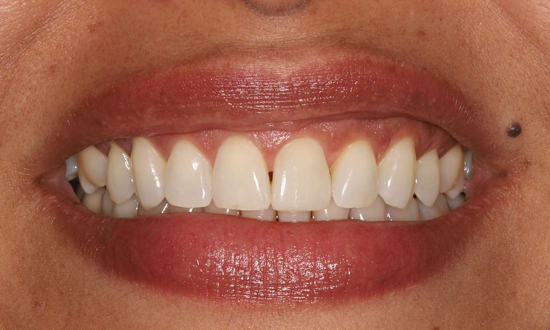 After Aligners, Bleaching, Composite Bonding