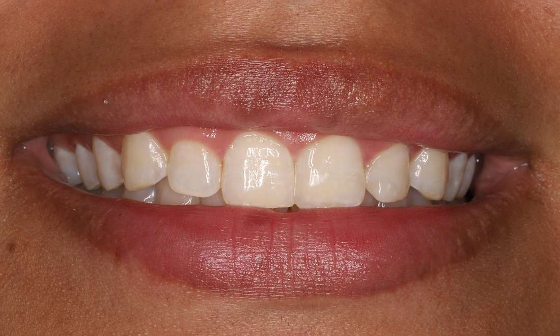 After treatment with direct composite veneers