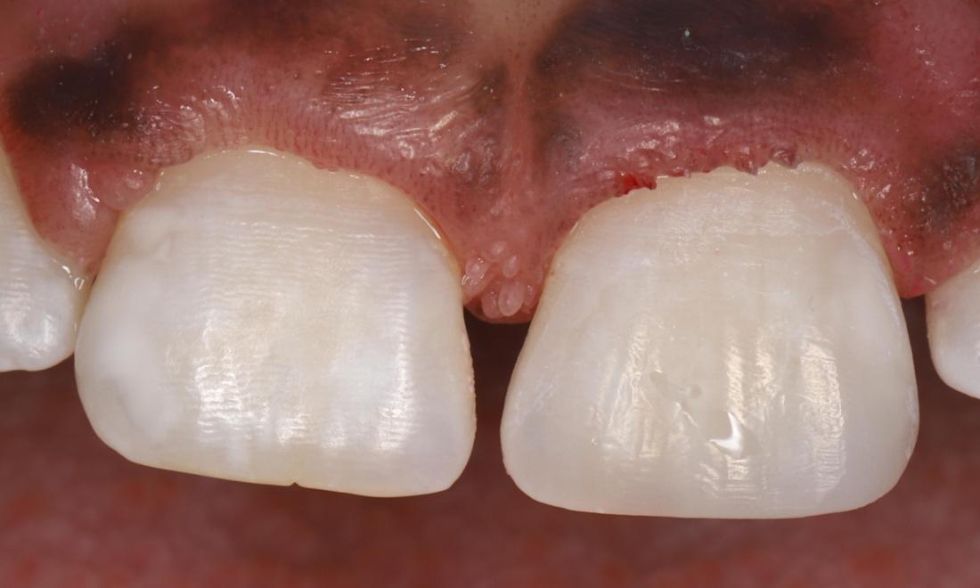 Front tooth repaired with tooth colored filling material