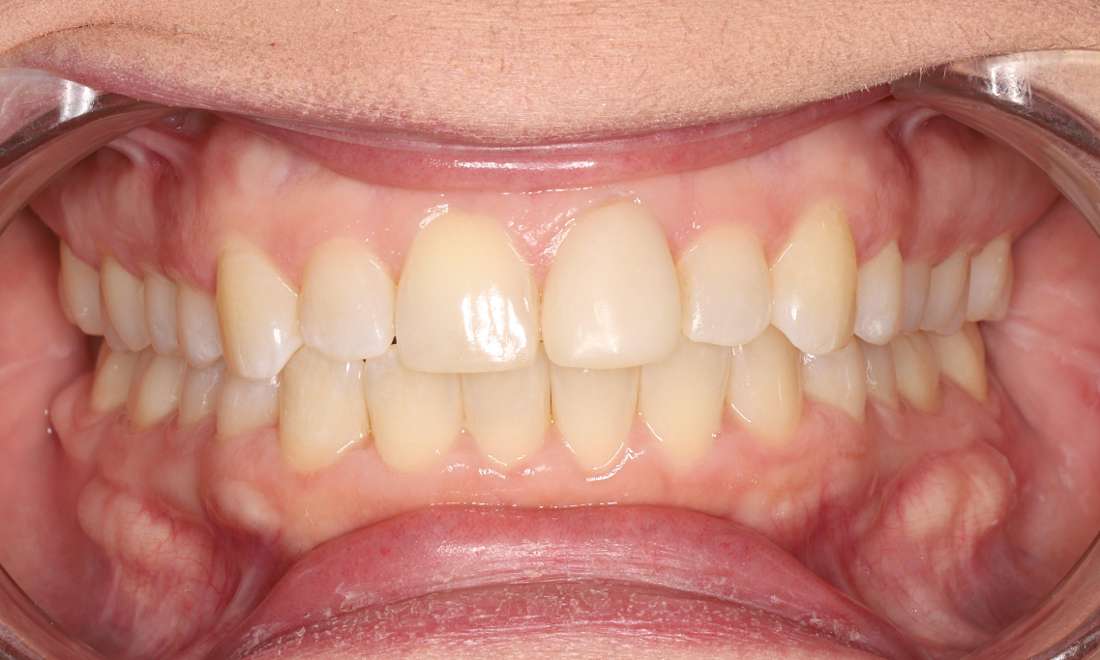 After aligners, 3D printed crown, level gum tissue, teeth aligned, edges more even