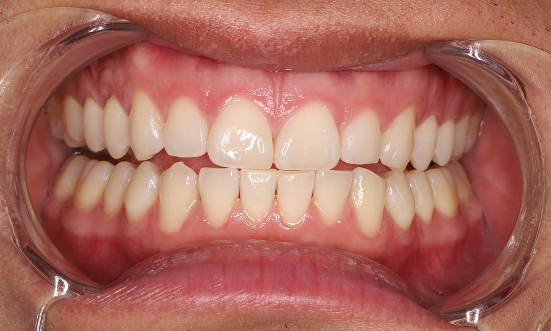 After treatment with Clear Correct aligners and composite bonding gap closure