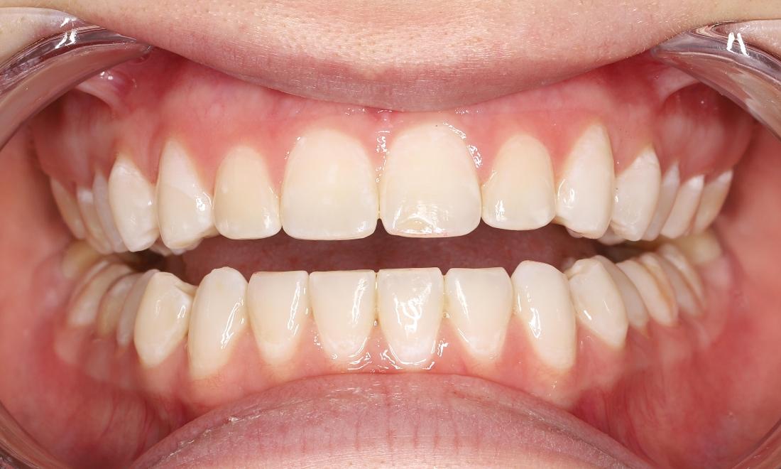 After orthodontic treatment, no space between the front teeth