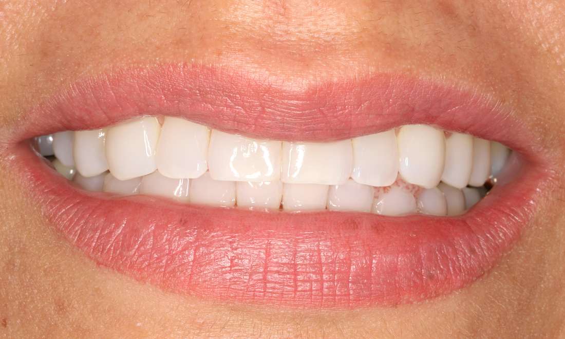 After treatment with direct composite fillings, crowns, dental implants, and Clear Correct Aligners