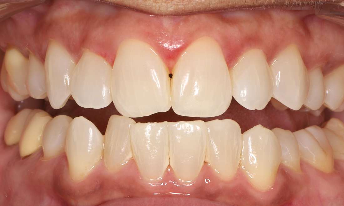 After tooth whitening with custom take-home whitening trays and opalescence