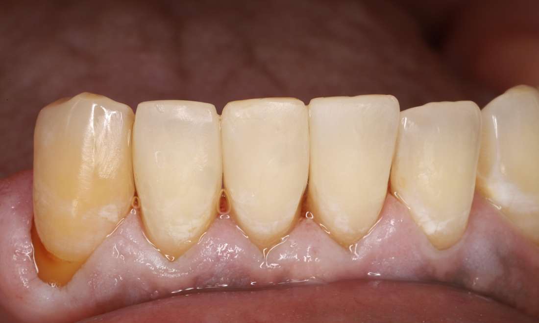 After treatment, spaces closed, contacts smooth