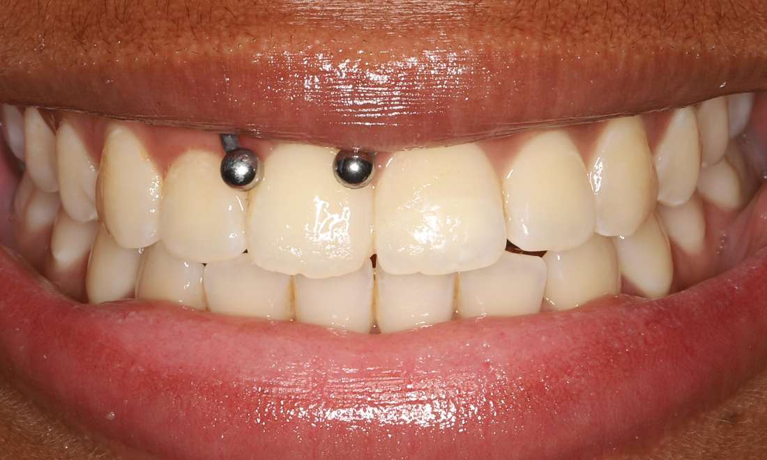 Tooth reattached