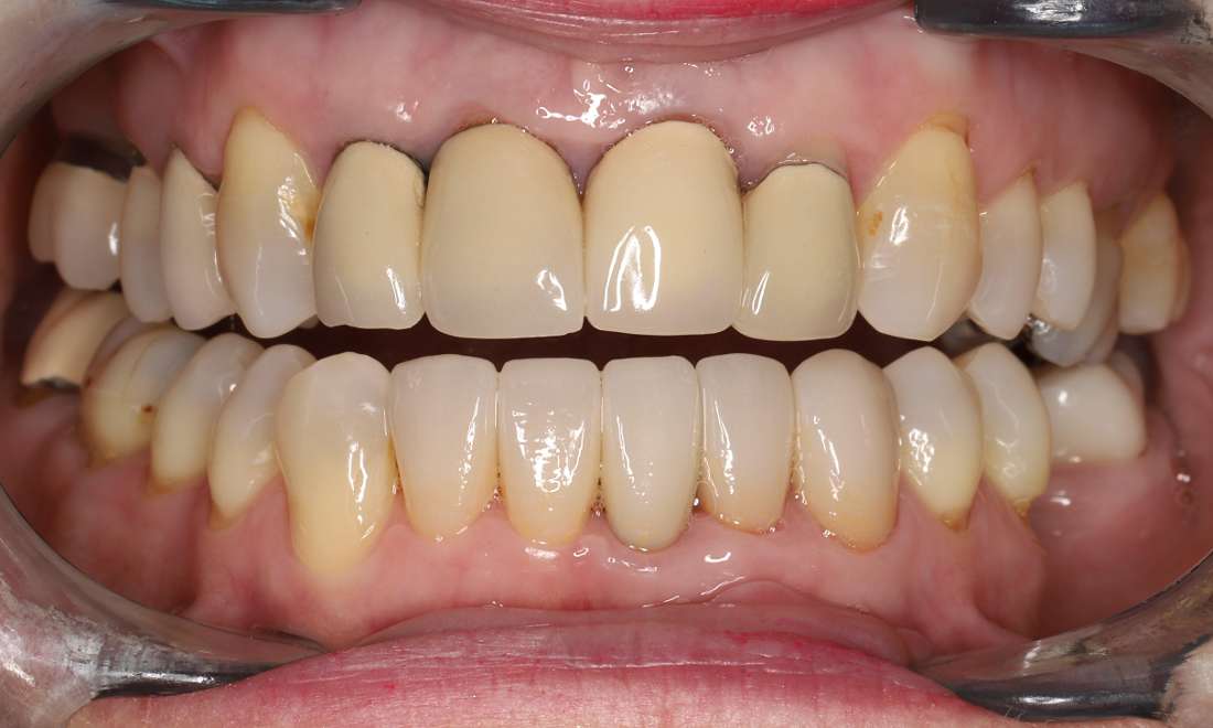 After treatment with five all ceramic crowns on the lower front teeth