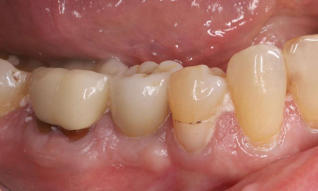 After treatment, immediate single tooth dental implant with custom titanium abutment and custom ceramic crown