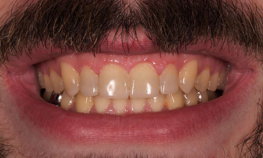 After treatment with direct composite veneers