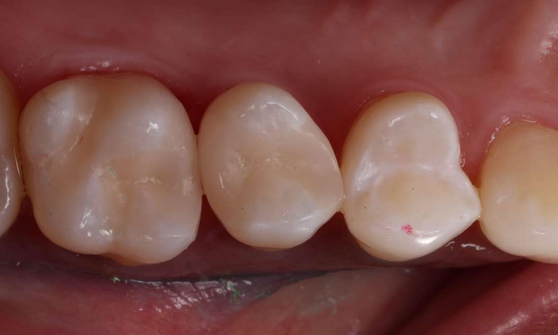After treatment with direct composite filling material