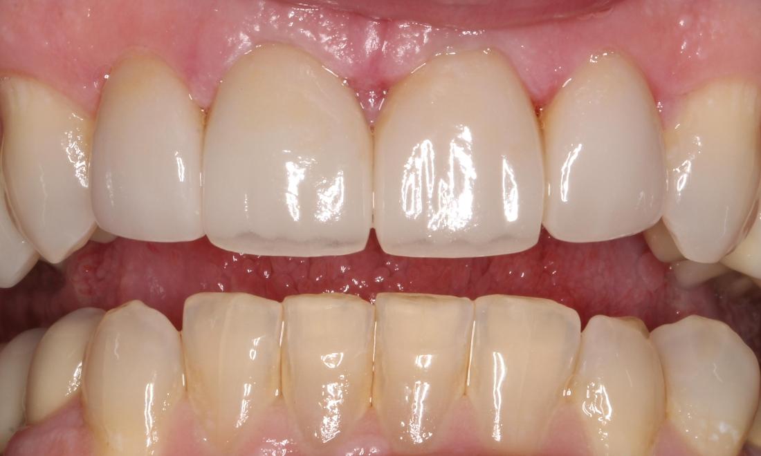 After treatment with two all ceramic crowns and two all ceramic veneers