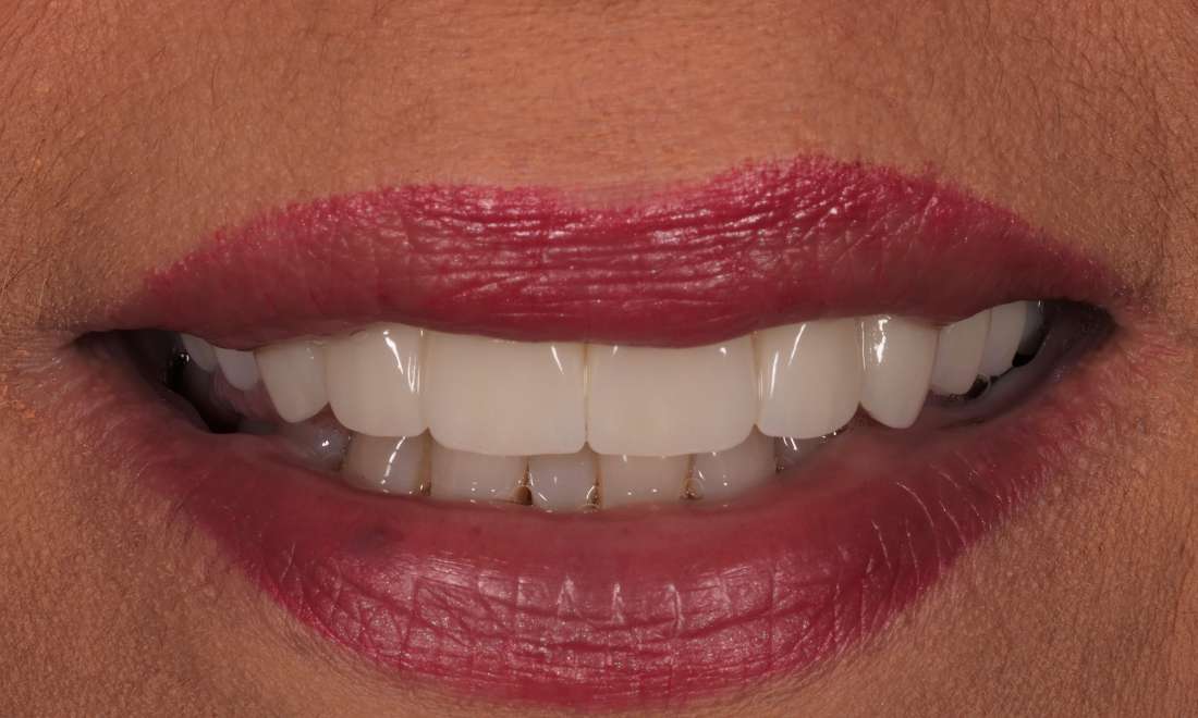 After treatment with improved gum health, root canals, extractions, and zirconia crowns and bridges