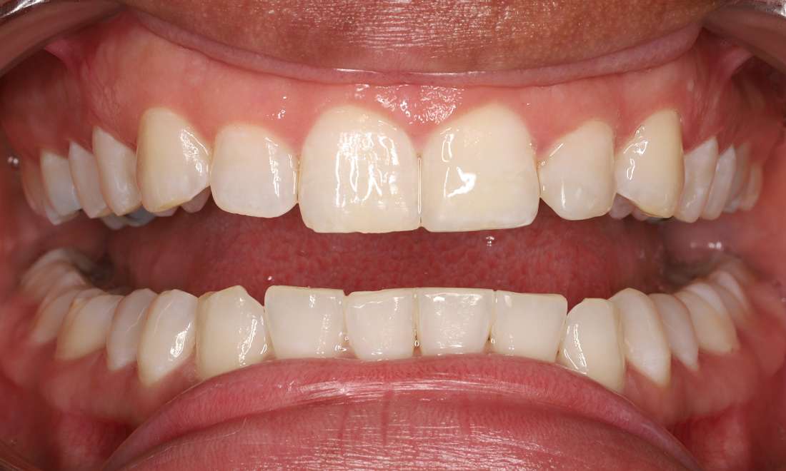 After treatment with direct composite veneers