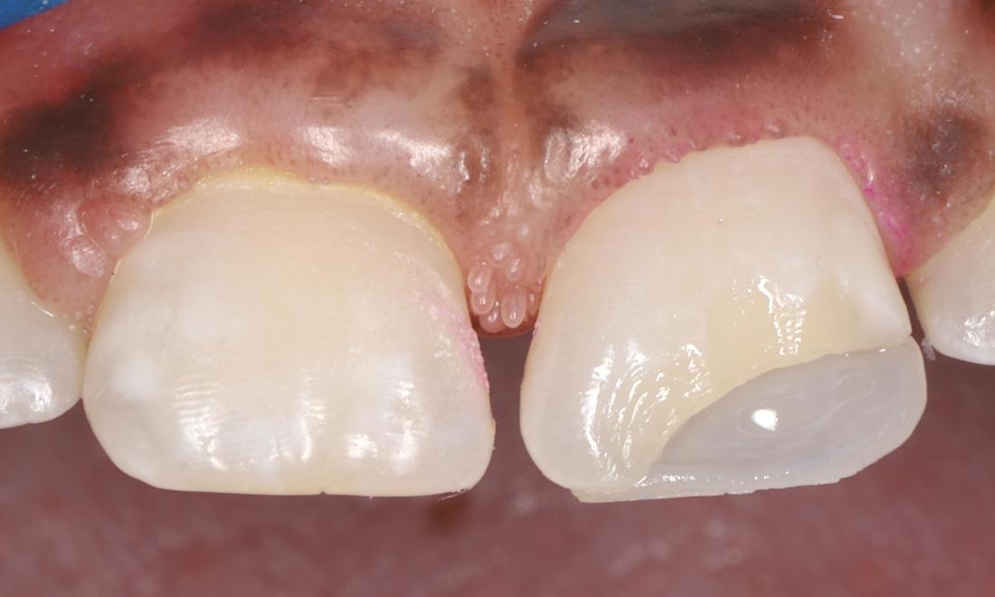 Fractured front tooth with first layer of tooth colored filling material