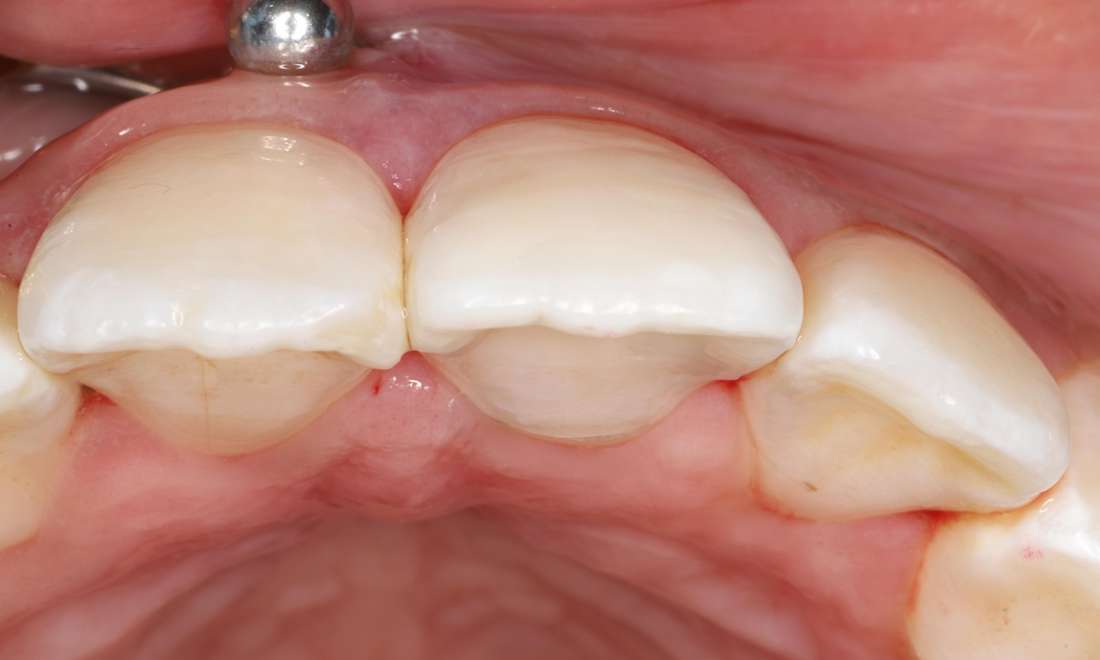 Reattached tooth immediately after treatment