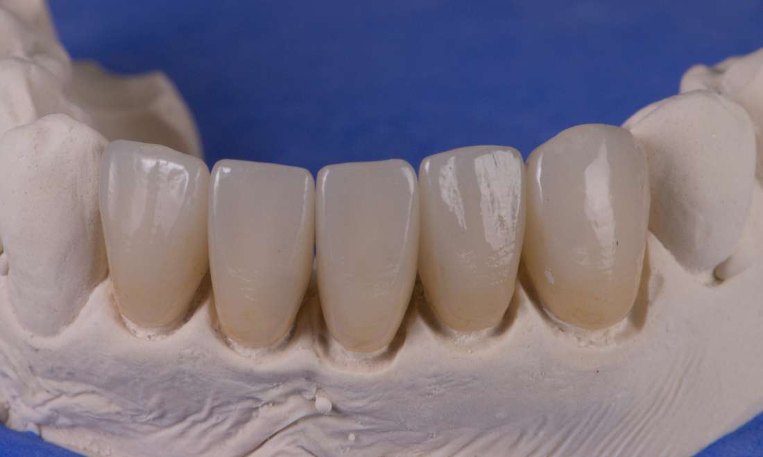 Five all ceramic crowns on solid model