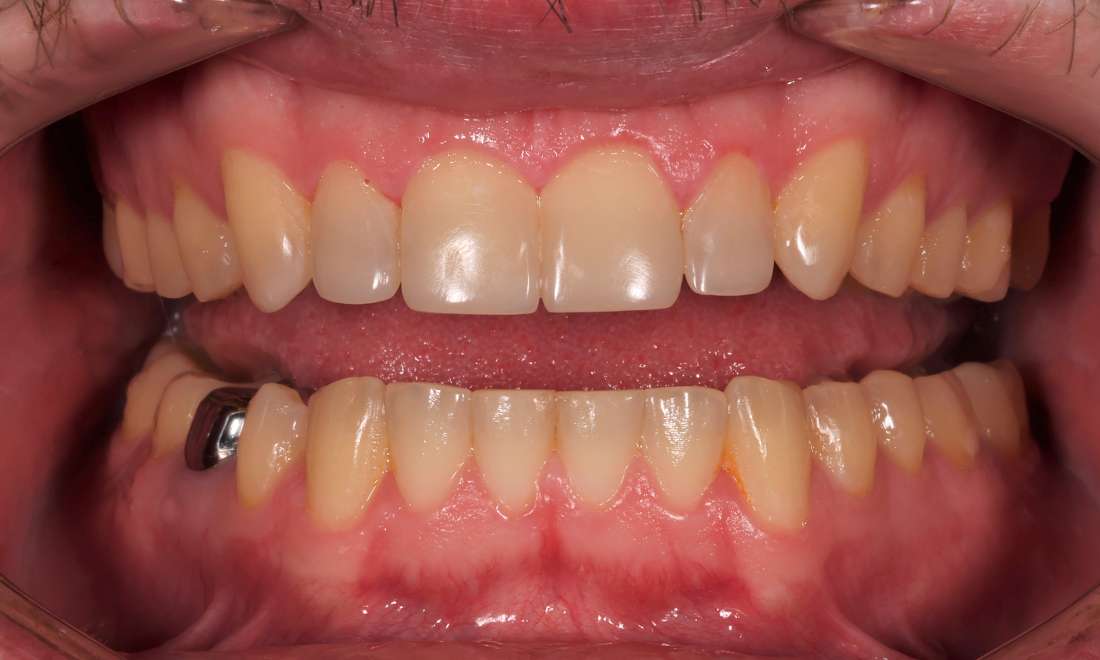 After treatment with direct composite veneers