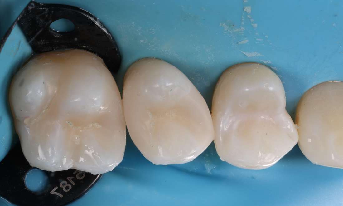 After treatment with direct composite filling material