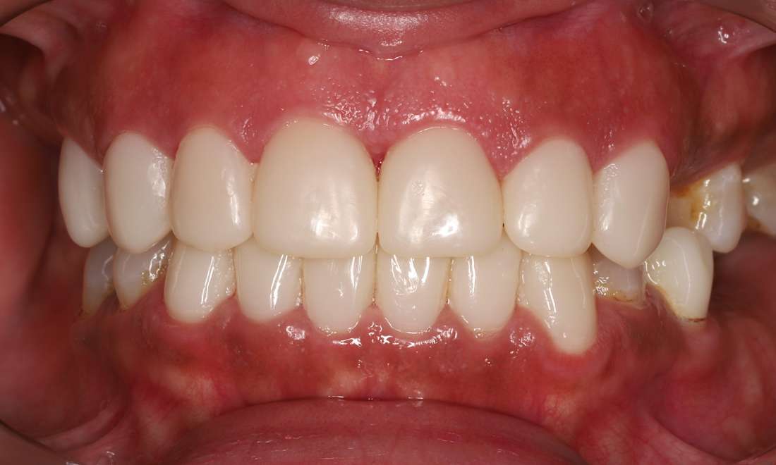 After treatment with 3D printed crowns
