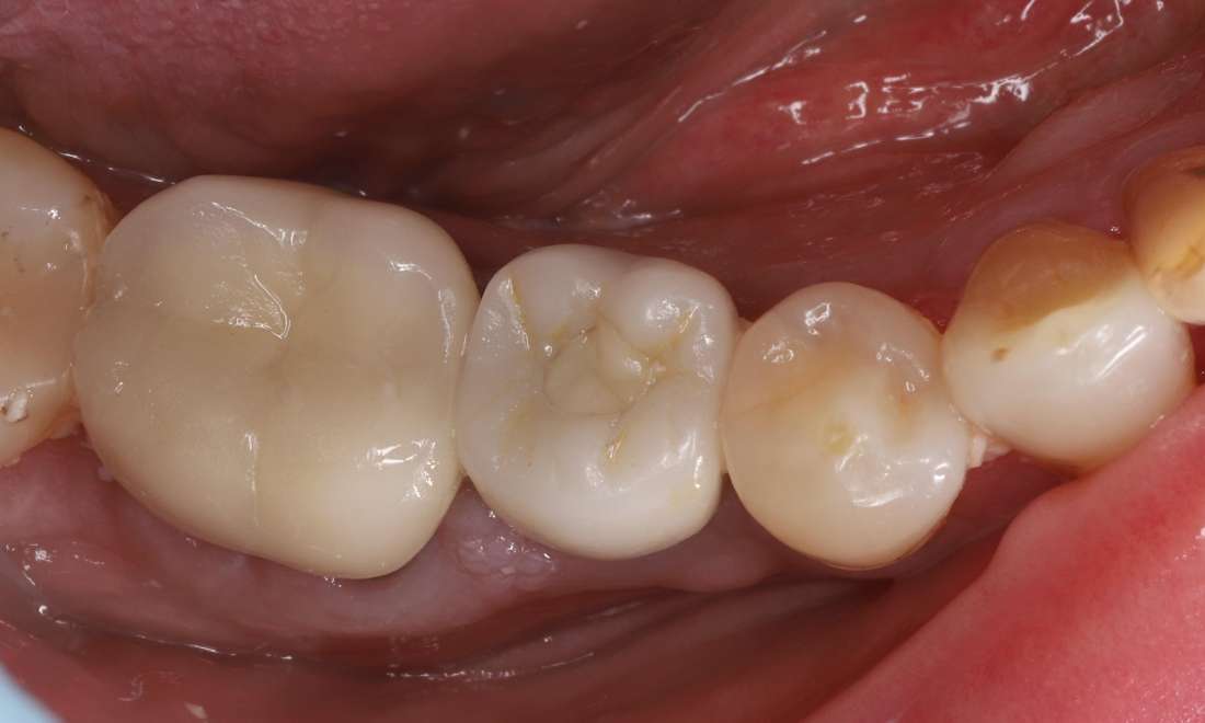 After treatment, immediate single tooth dental implant with custom titanium abutment and custom ceramic crown