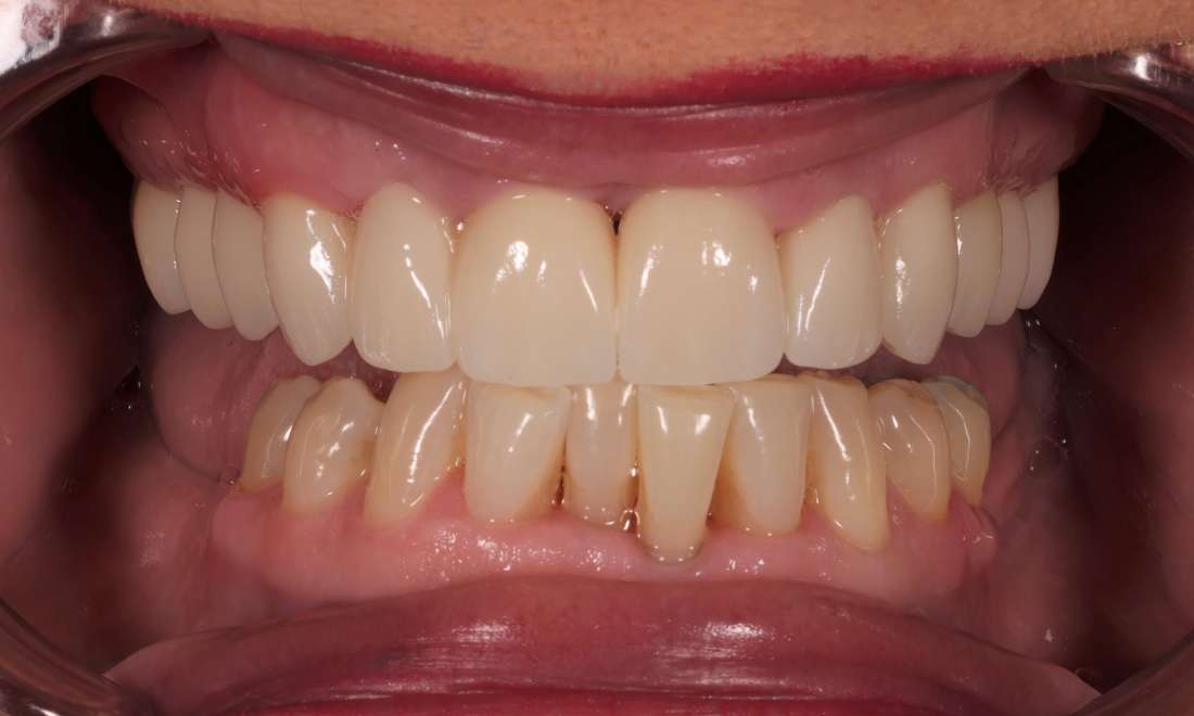 After treatment with improved gum health, root canals, extractions, and zirconia crowns and bridges