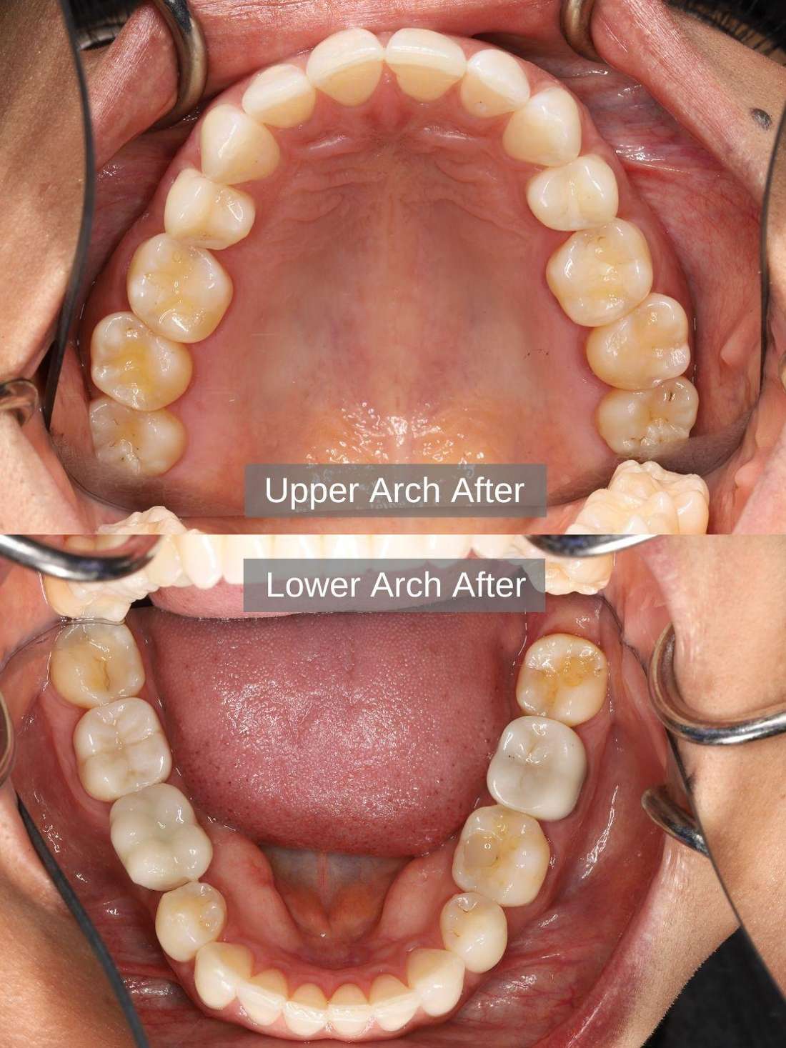 After Aligners, Bleaching, Composite Bonding