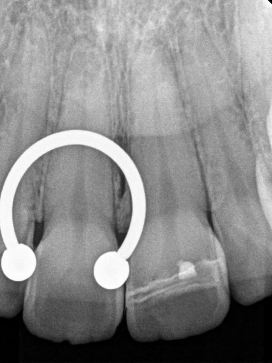 x-ray of reattached tooth