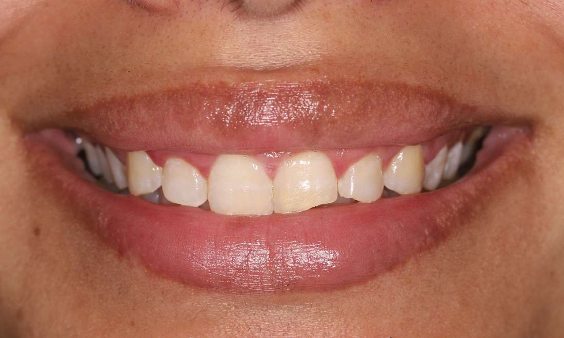 Before treatment, chipped teeth on upper left