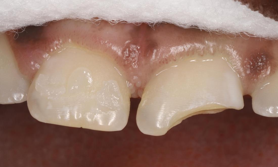 Fractured front tooth