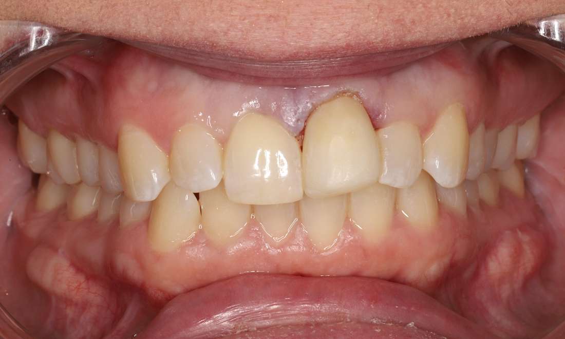 Before Clear Correct, misaligned teeth, uneven gums, uneven tooth edges