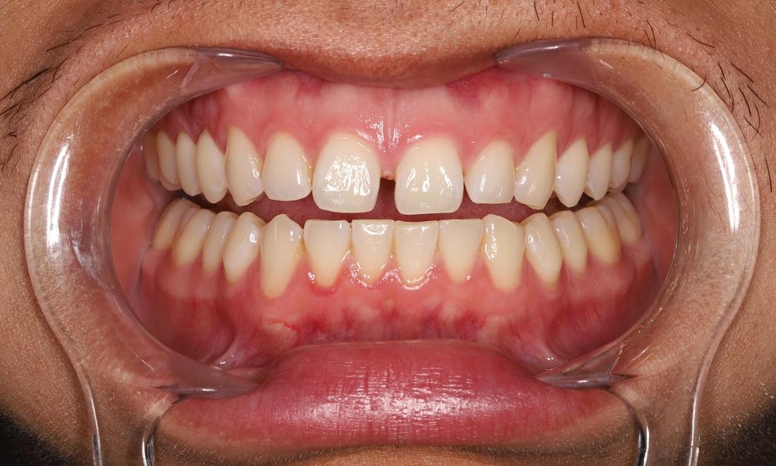 Before treatment, gaps between upper teeth, crowded lower teeth