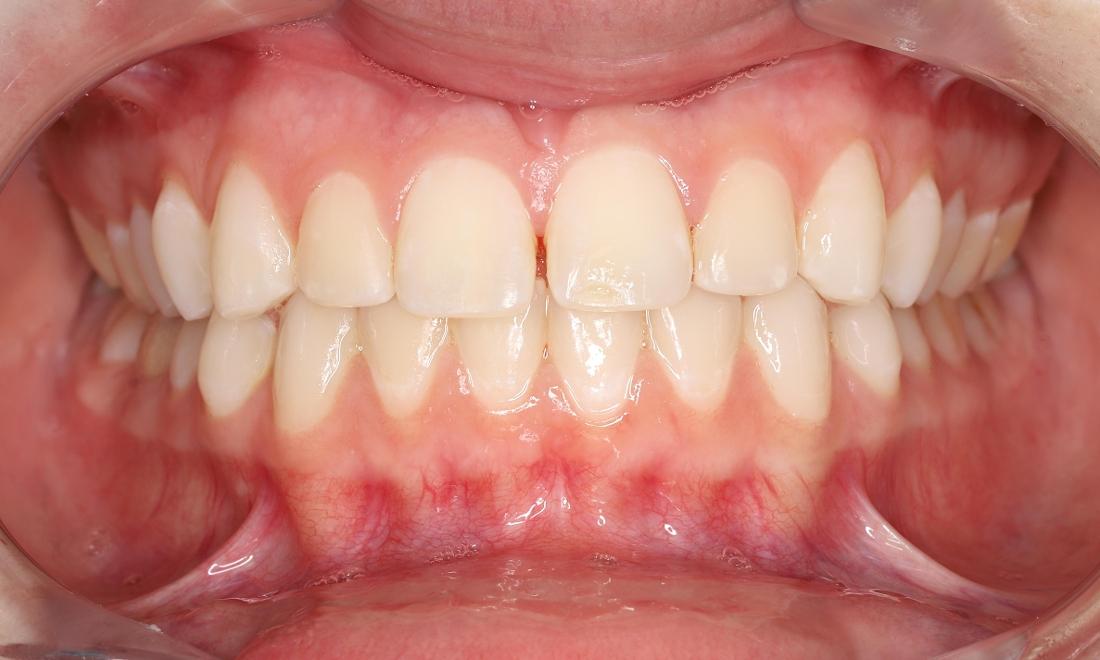 Gap between front teeth before orthodontic treatment