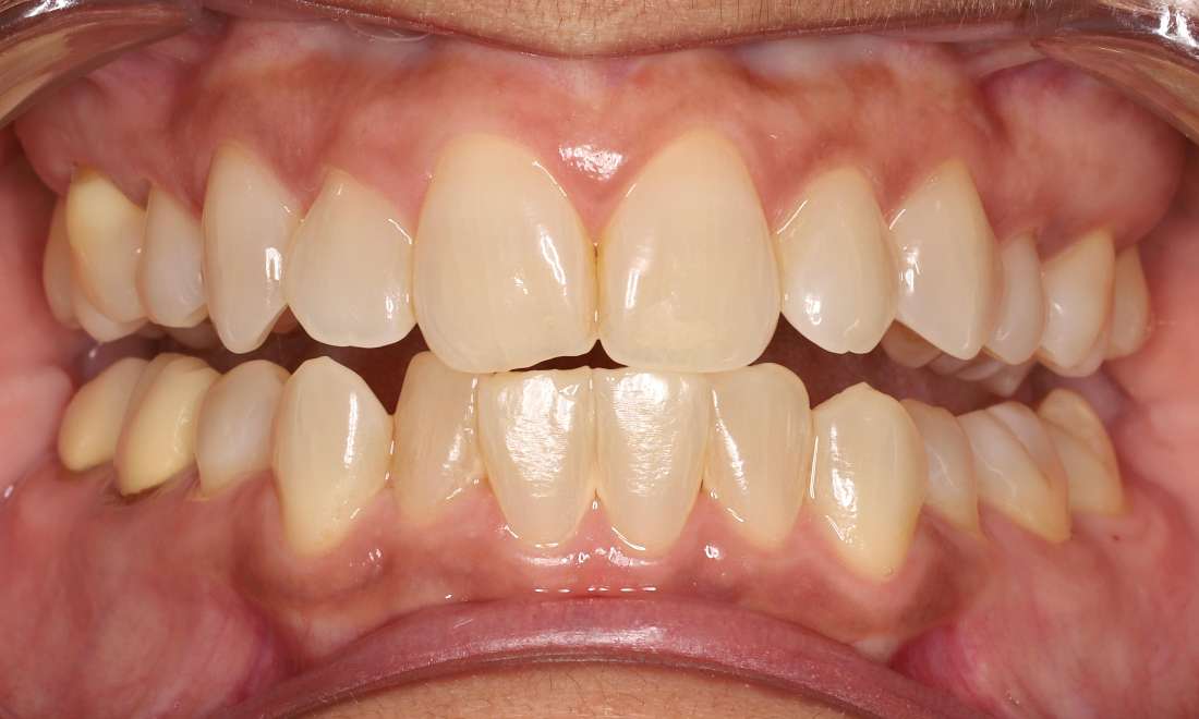 Before tooth whitening with opalescence 