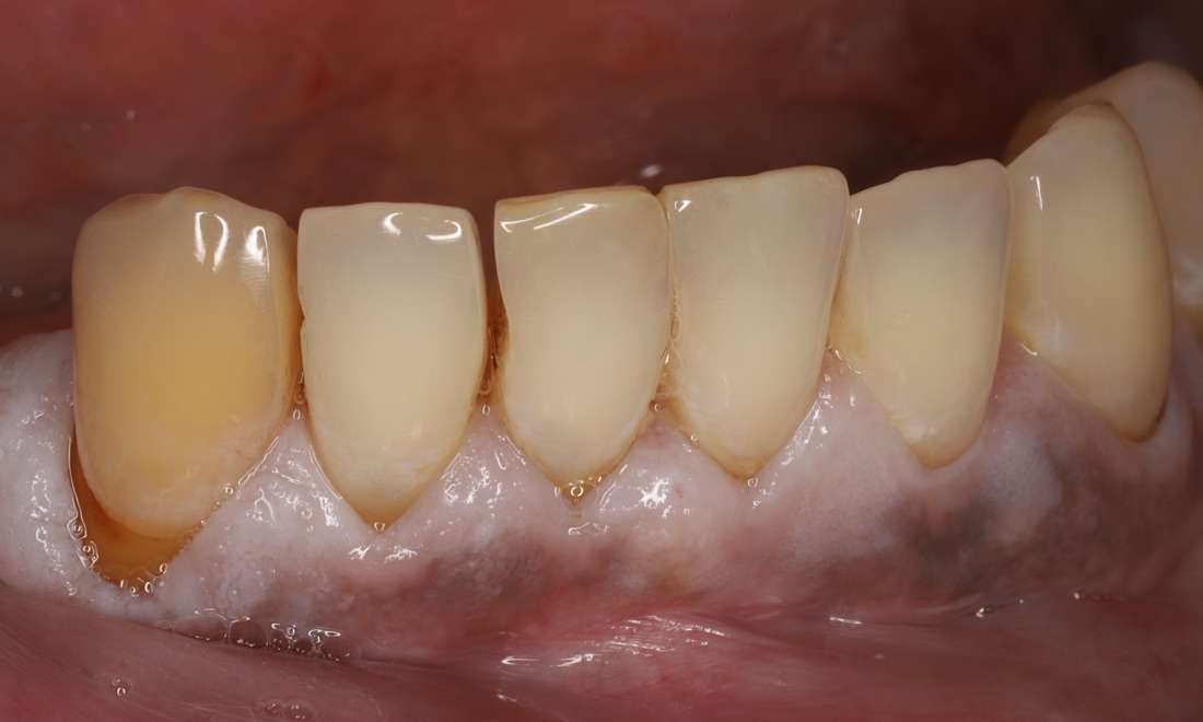 Before treatment, open and irregular spaces between teeth with decay
