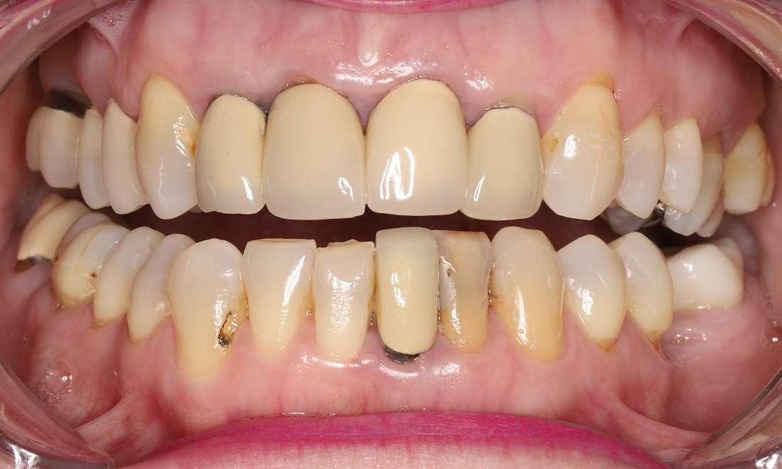 Before Treatment, uneven edges and color of lower front teeth