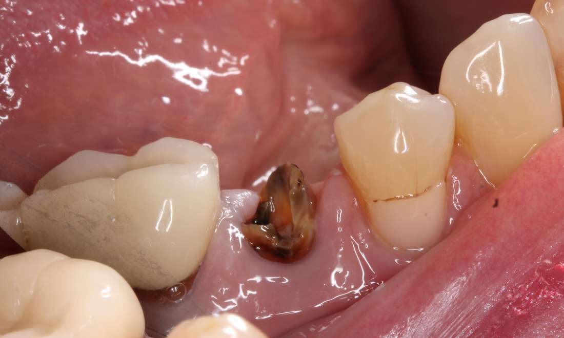 Before treatment, fractured tooth with missing crown and previous root canal, non-restorable