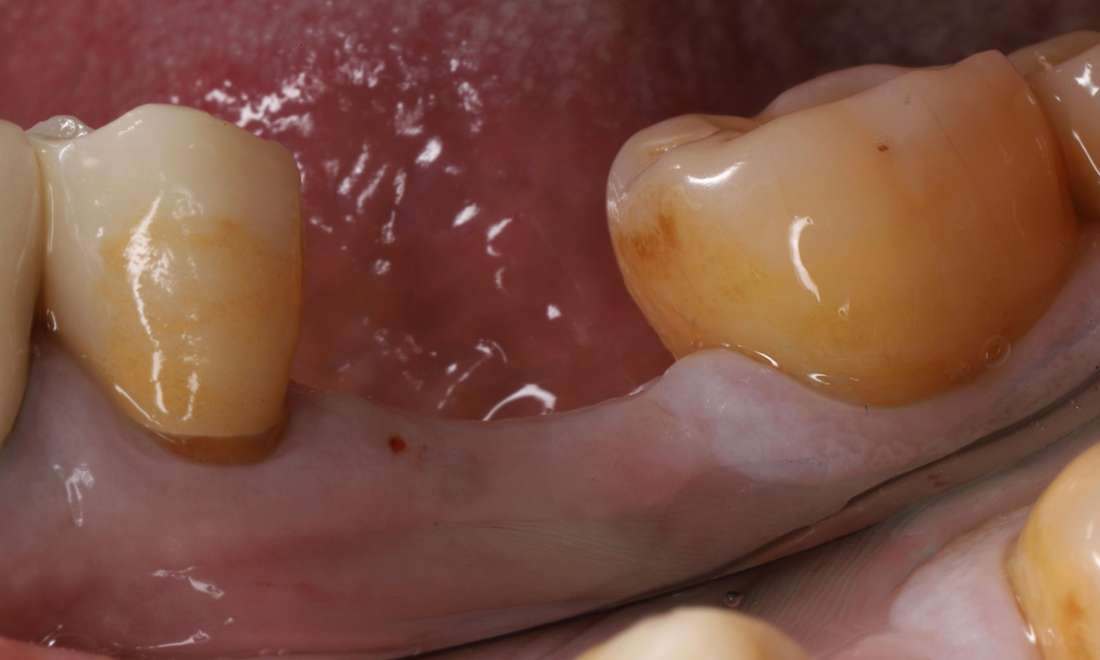 Missing molar before replacement with a dental implant