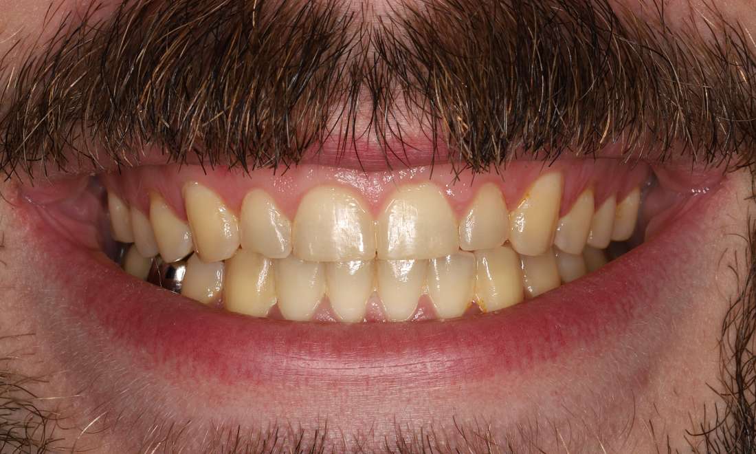 Before treatment with direct composite veneers