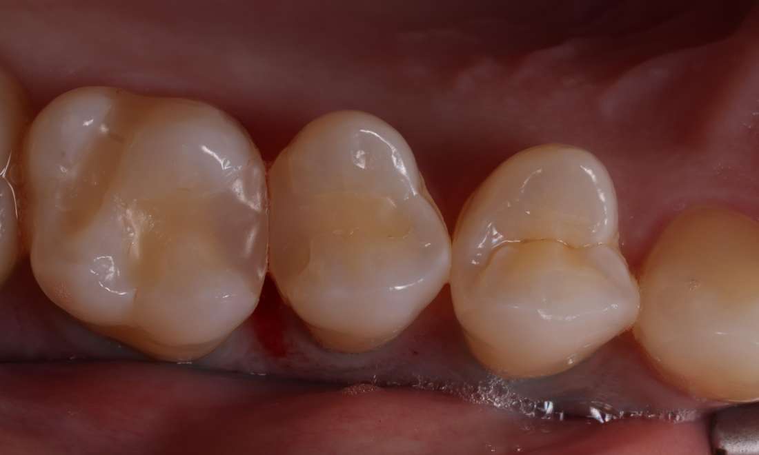 Before treatment with decay under old fillings