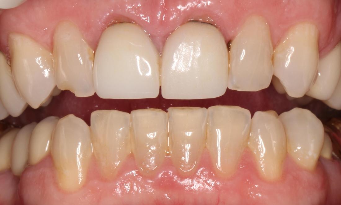 Before treatment, existing porcelain to metal crowns, chipped tooth