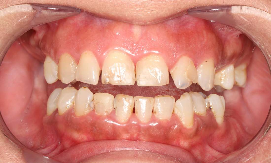 Before treatment with wear, decay, and acid erosion around existing composite bonding