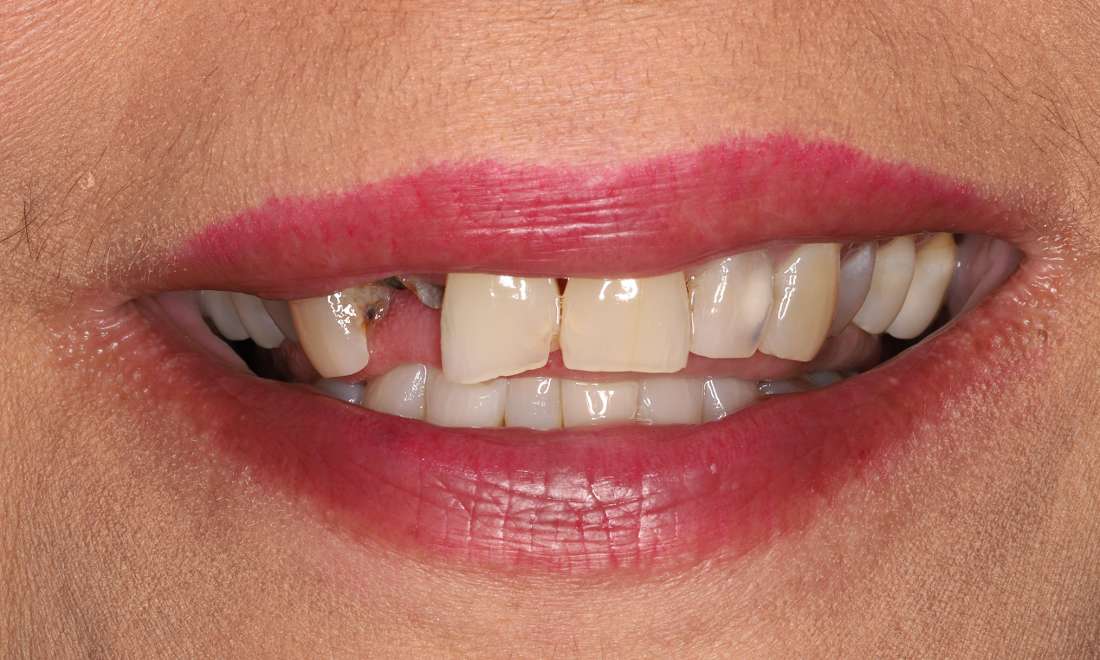 Before treatment, multiple missing, decayed, hopeless teeth