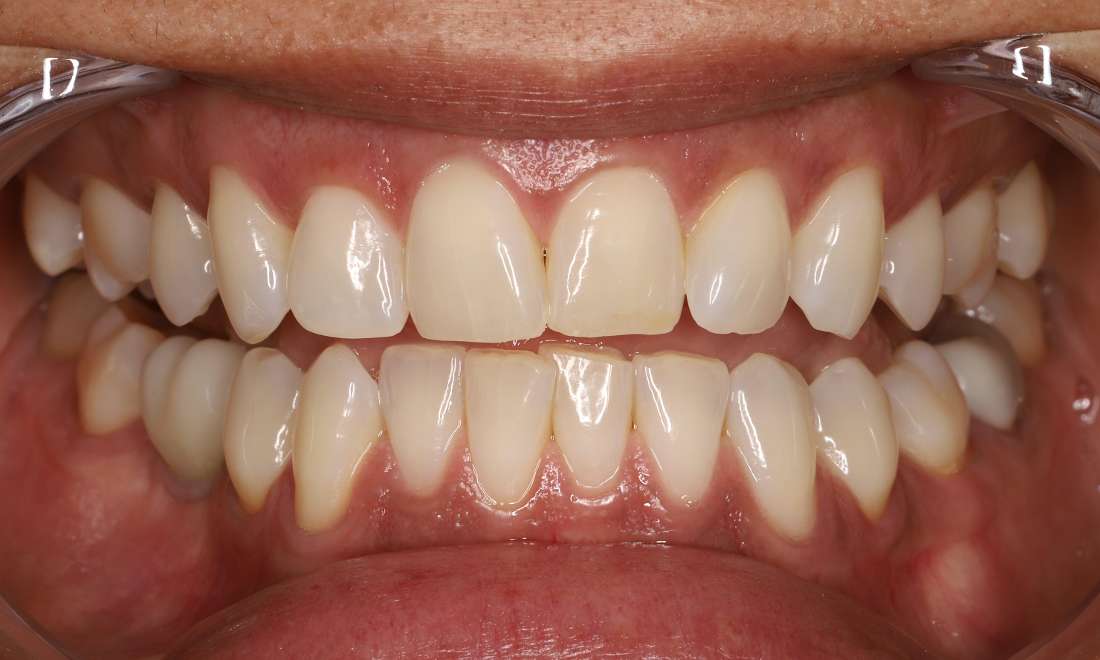 Before Aligners, Bleaching, Composite Bonding