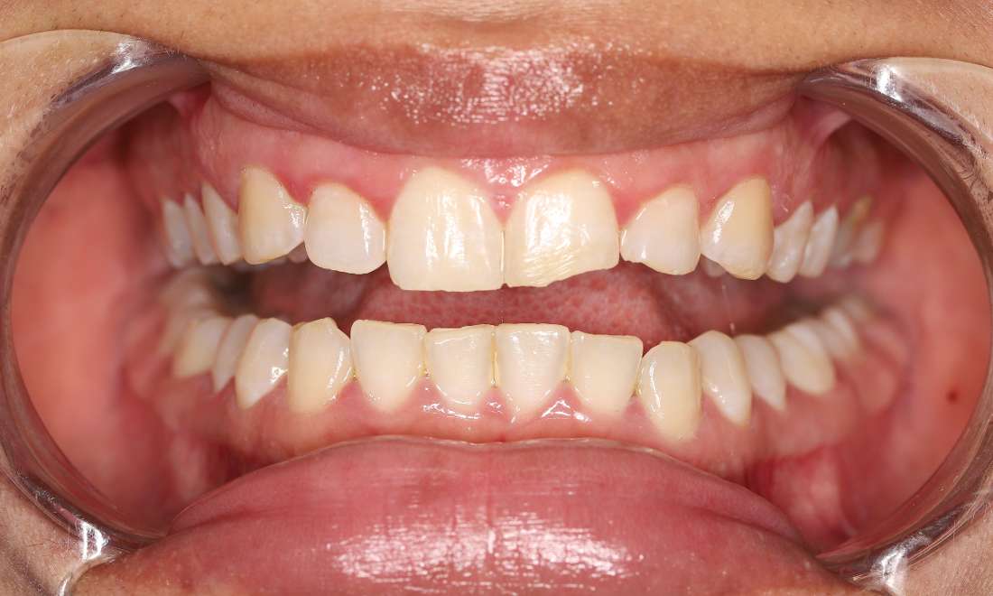 Before treatment, chipped teeth on upper left