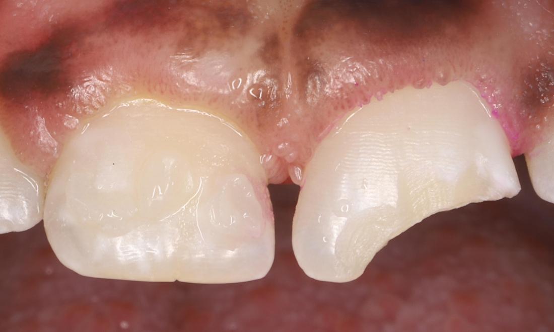 Fractured front tooth with bevel