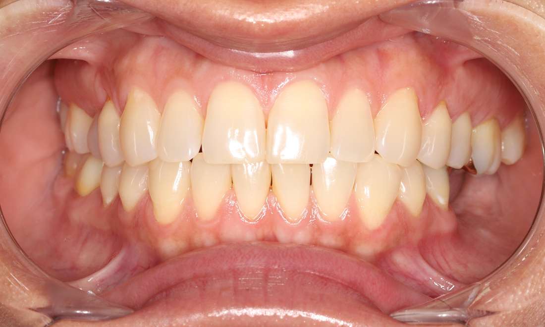 Before treatment, spaces between teeth, multiple teeth with cavities, missing teeth