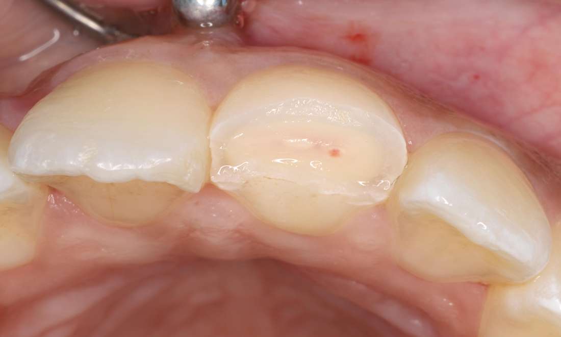 Fractured tooth with exposed pulp