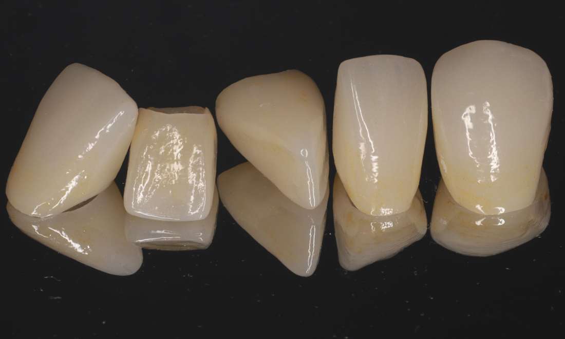 Five all ceramic crowns
