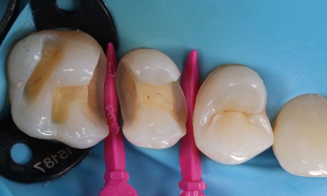 During treatment after removing the decay and old filling material