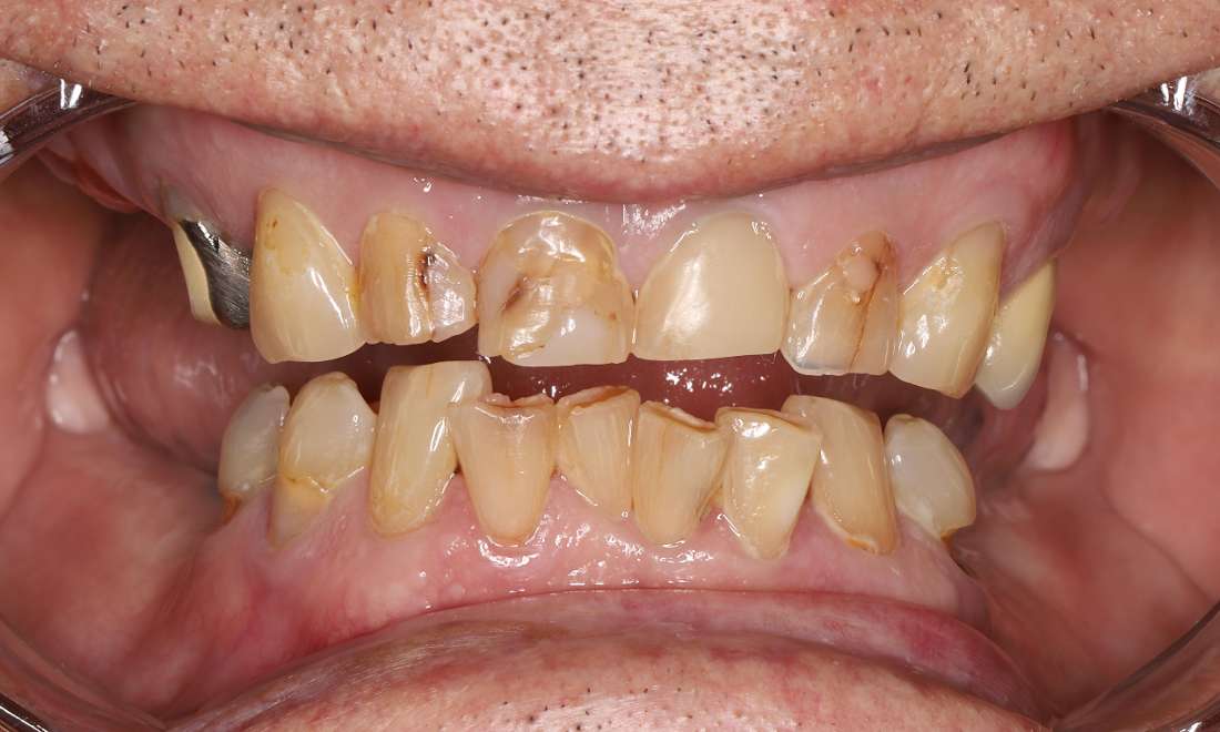 Before treatment, multiple decayed, chipped, missing teeth